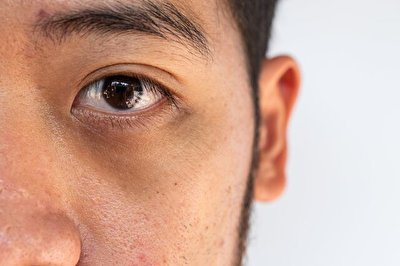 علت سیاهی زیر چشم چیست؟